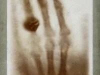 La fascinante hisotria de la primer&nbsp;radiografía